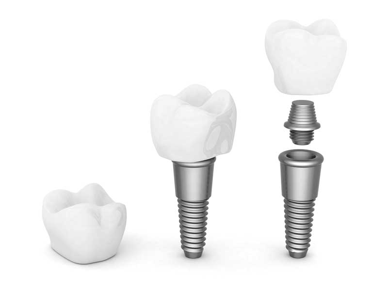  Avantatges implants dentals